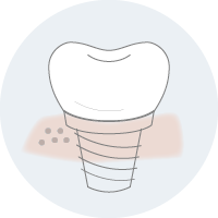 dental implants wellington.