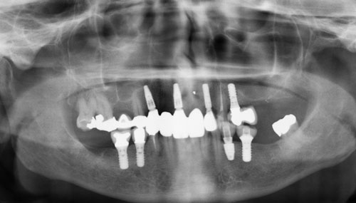 xray of implants in jaw